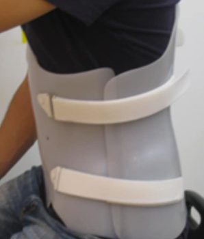 Fig.1- Corsé lumbar rígido de polietileno, bivalvo a medida.