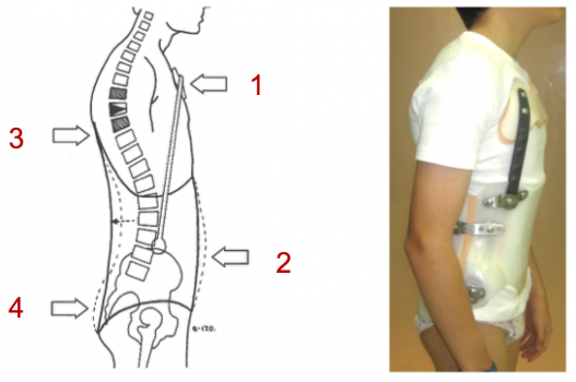 Fig. 3)  Acción biomecánica del corsé M-A en casos de hipercifosis.